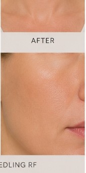 After Microneedling