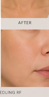 After Microneedling