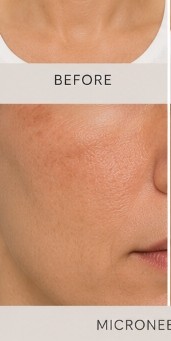 Before Microneedling