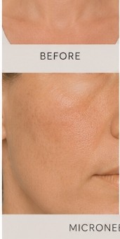 Before Microneedling