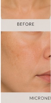 Before Microneedling
