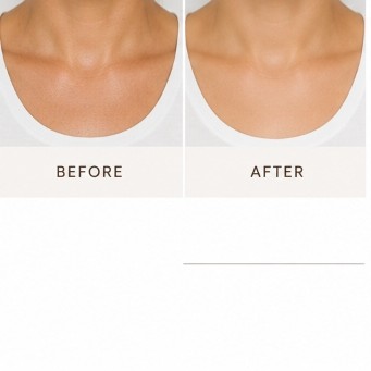 After Acne Peel