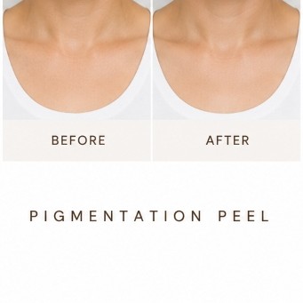 After Acne Peel