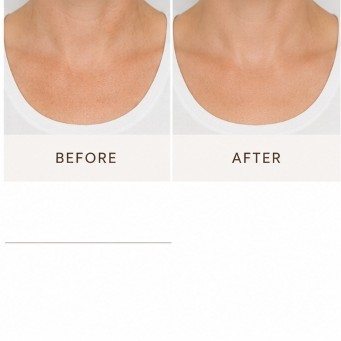 After Acne Peel