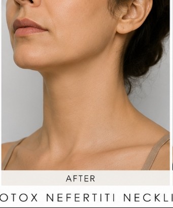 After Nefertiti Neck Lift