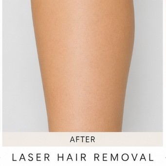 After Exciplex Alopecia Treatment