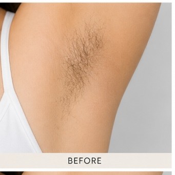 Before Exciplex Alopecia Treatment