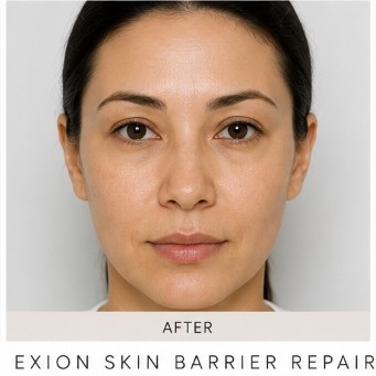 After Skin Tightening RF